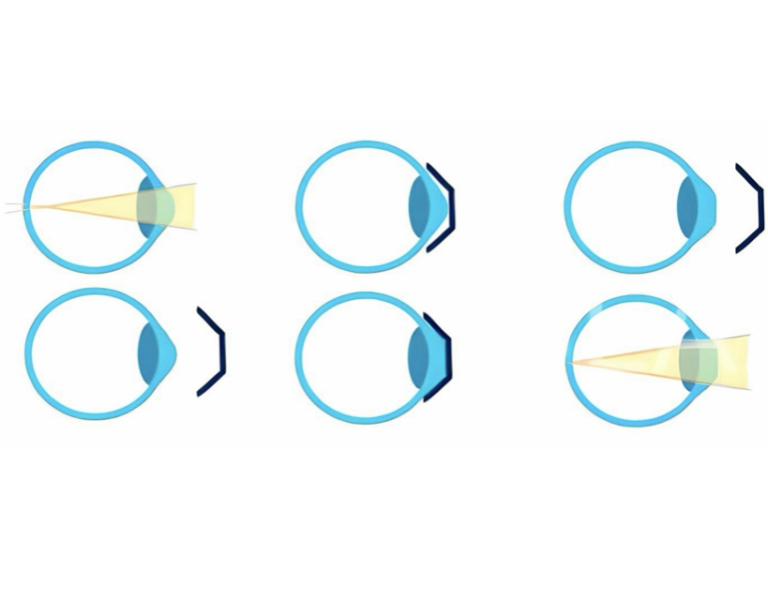 Ортолінзи для корекції зору та профілактики міопії в офтальмологічній клініці